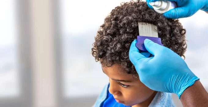 Can Black People Get Lice and Are They Infectious?