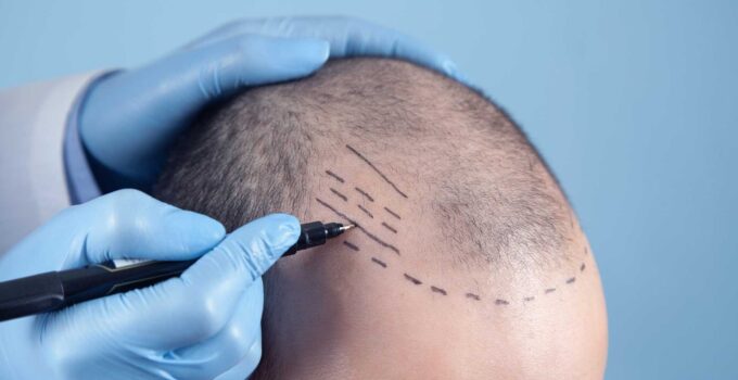 Top 10 Best Hair Transplant Clinics in the World
