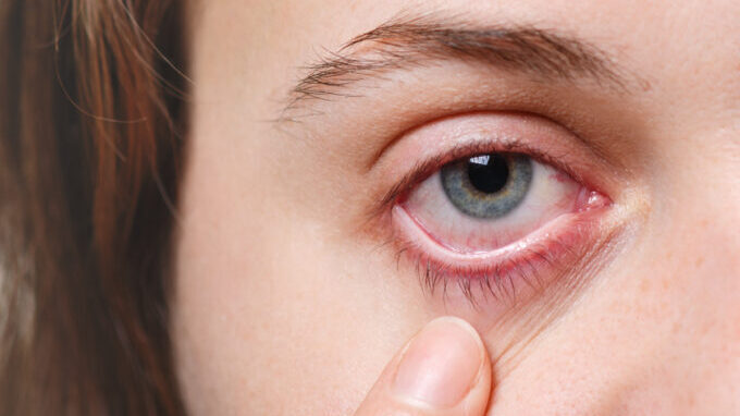 does LASIK lead to permanent dry eyes