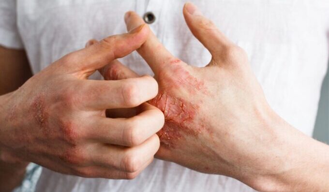 Understanding Eczema