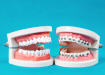 When Were Dental Braces Invented: A Historical Perspective
