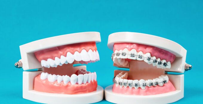 When Were Dental Braces Invented: A Historical Perspective