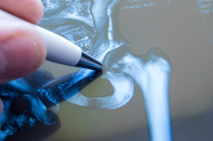 The Signs You Need Hip Replacement Surgery
