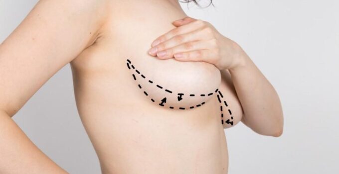 From Sagging to Stunning: Breast Lifts for a Youthful You