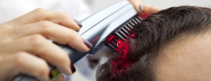 Hair Loss Laser Treatments